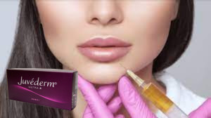 Juvederm Ultra 3 Hyaluronic Acid HA Dermal Filler 2ml होंठ बढ़ाने वाला