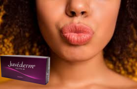 Juvederm Ultra 3 Hyaluronic Acid HA Dermal Filler 2ml होंठ बढ़ाने वाला