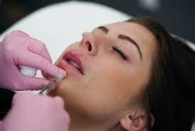 Hyaluronic एसिड इंजेक्शन योग्य त्वचा भराव Juvederm Ultra 3 1mlx2